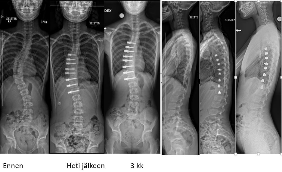 Röntgenkuvat ennen ja jälkeen pingotusleikkauksen.