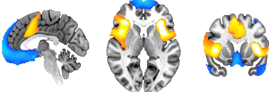 Aivot kuvattuna sivulta, yläpuolelta ja takaa. Aivoihin merkitty alueita keltaisella ja sinisellä värillä.