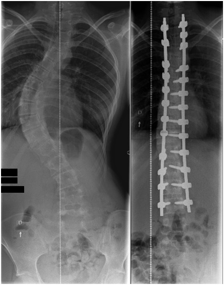 Röntgenkuva skolioosista ennen ja jälkeen operaation.