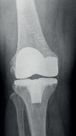tekonivelproteesi polvessa röntgenkuvassa.